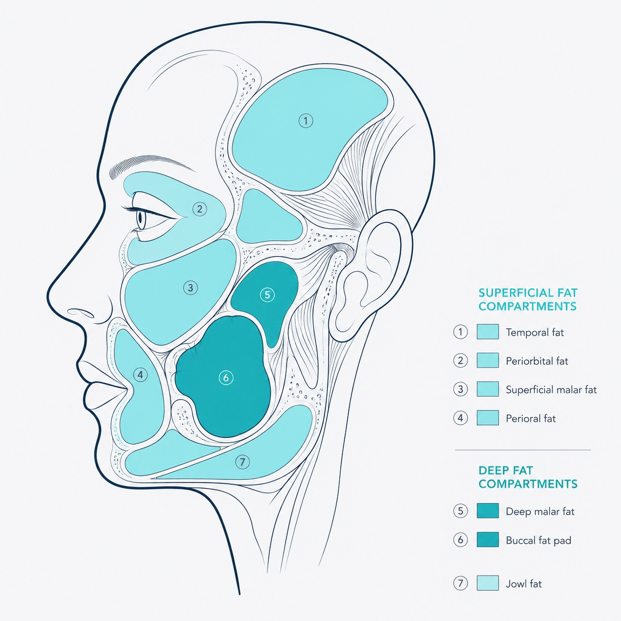 Ilustración anatómica de los compartimentos grasos faciales: malar, bucal, temporal, periorbitaria y mandibular.
